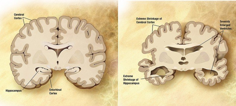 Alzheimer Tanımı, Belirtileri ve Tedavisi