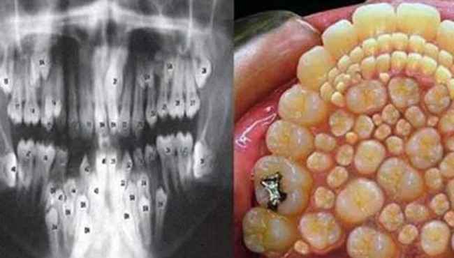 Hiperdonti Yani Çoklu Diş Hastalığı