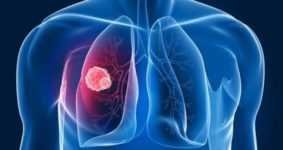 Erkeklerde Akciğer Kanserinin Erken Belirtileri Nelerdir?