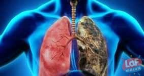 Akciğer Kanseri ve Risk Faktörleri