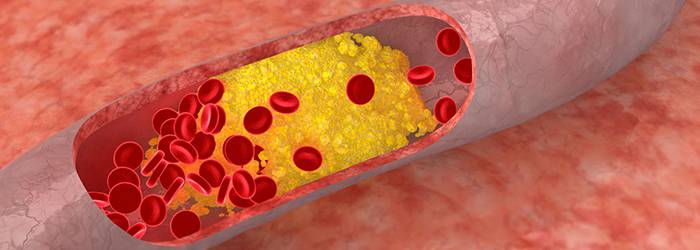 Kolesterol damarları nasıl tıkar?