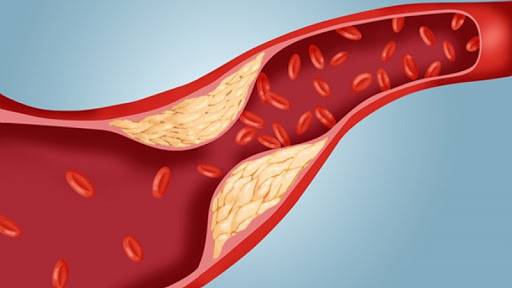 Kolesterolün damardaki etkisi