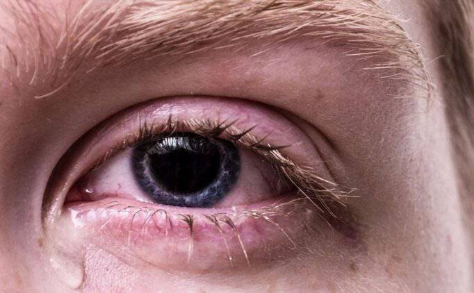 Göz Alerjisi Nasıl Geçer: Göz Alerjisine Bitkisel Çözümler