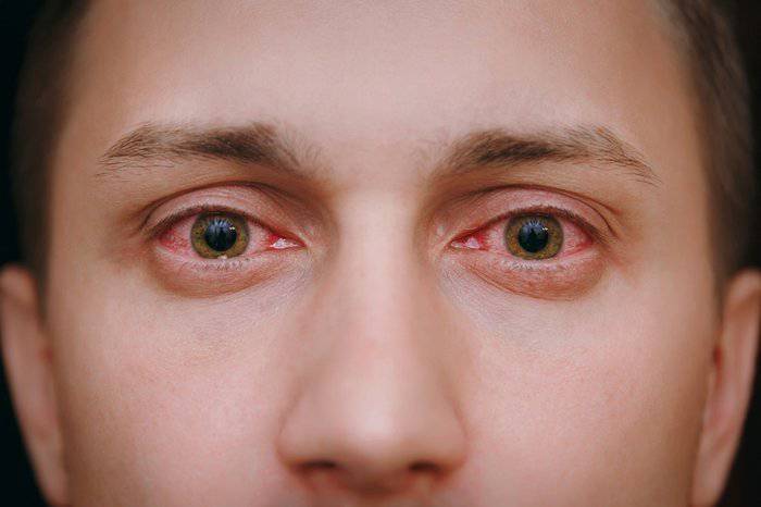 Göz alerjisine ne iyi gelir?