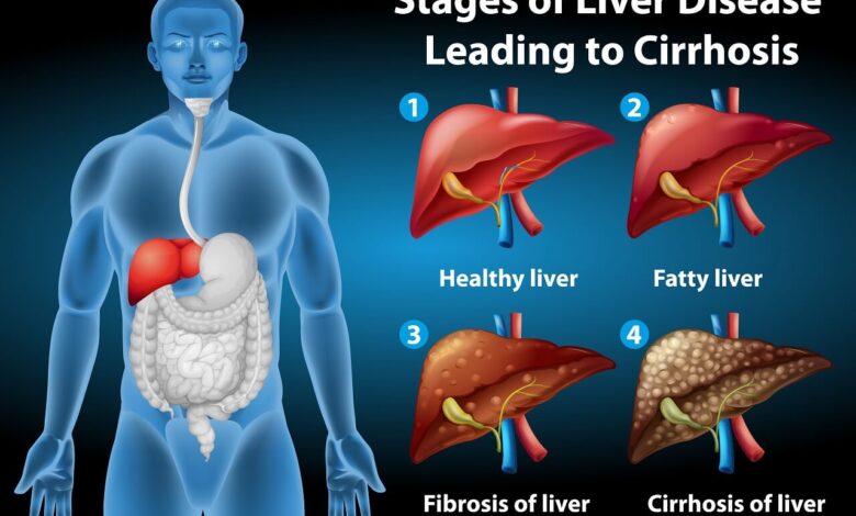 Karaciğer Yağlanmasının Nedenleri, Belirtileri ve Tedavisi