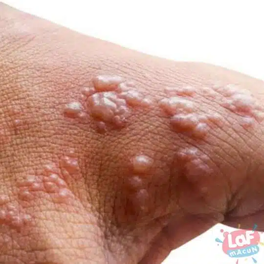 Elde Küçük Su Kabarcıkları Neden Çıkar? Nasıl Geçer? 2 Su Kabarcıkları Nasıl Geçer?