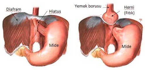 Mide Fıtığı Belirtileri