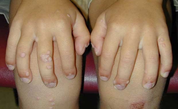 Parmaklarda oluşan siğilin sebebi nedir?