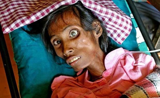 AIDS (HIV Virüsünün Neden Olduğu Bağışıklık Sistemi Yıkımı)